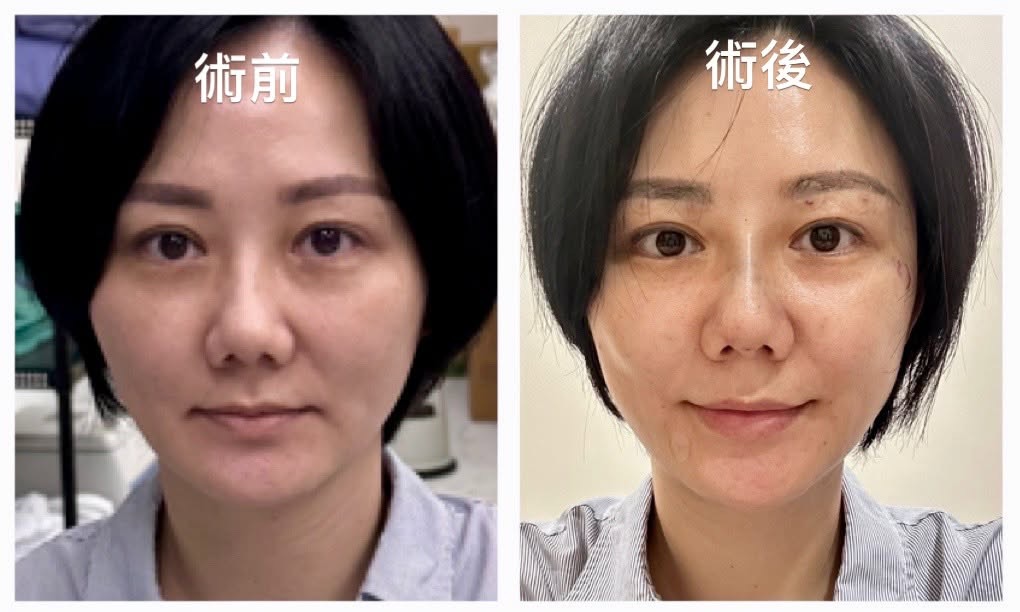 單次 50 條 MINT 線術前術後對照